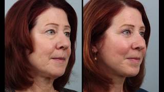 Day By Day Weekend Mini Facelift amp Blepharoplasty Recovery [upl. by Sanchez]