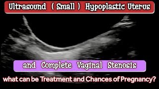 Ultrasound Small Hypoplastic Uterus and Vaginal Stenosis [upl. by Watts]