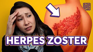 Como se pega Herpes Zoster [upl. by Hcurab]