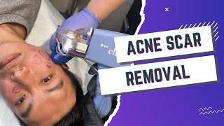 SCARLESS ACNE SCAR REMOVAL TREATMENT  Dr Jason Emer [upl. by Atla]