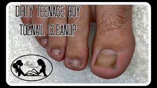 Pedicure How to Clean Dirty Teenage Boy Toenails [upl. by Eikciv]