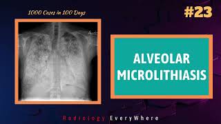 Pulmonary Alveolar Microlithiasis  Radiology Everywhere  1000 cases in 100 days  video 23 [upl. by Gomez]