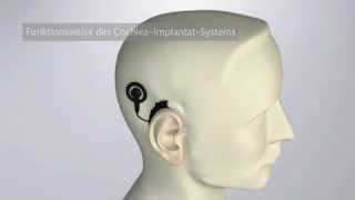 Funktionsweise des cochleaimplantatsystem [upl. by Harwell]