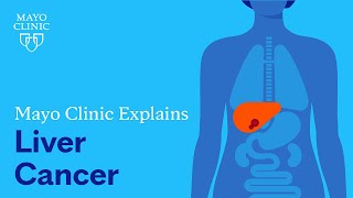 Mayo Clinic Explains Liver Cancer [upl. by Eiramnerual]