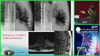 2019第八屆台灣脊椎微創醫學會會員大會暨學術研討會Symposium V Spinal Infection1周伯鑫蔡宗廷吳鴻康 [upl. by Lavelle]