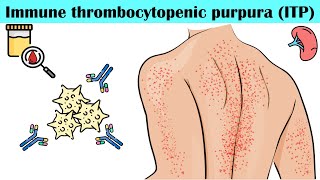 Immune Thrombocytopenic Purpura ITP  Causes Pathogenesis Signs amp Symptoms Diagnosis Treatment [upl. by Aikcir]