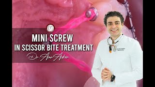 orthodontic mini screw in scissor bite treatment by Dr Amr Asker [upl. by Barrow]