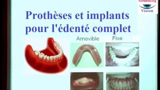 Prothèse dentaire fixe et amovible sur implant pour lédenté complet [upl. by Sheaff928]