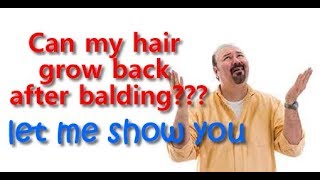 Can Hair Grow Back After Balding [upl. by Ailahtan]