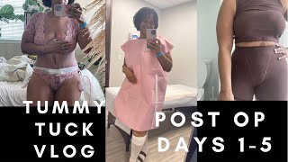 My Abdominoplasty journey Days 15 post surgery pics  My Mother’s Day [upl. by Lyrehs]