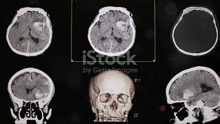 The Clandestine Craniotomy JFKs Unseen Autopsy [upl. by Sharyl]