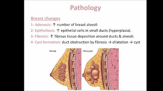 Fibroadenosis [upl. by Naira]