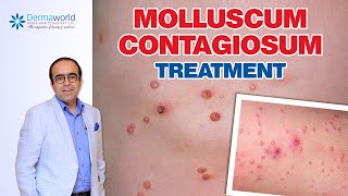 Molluscum Contagiosum Treatment  Dr Rohit Batra [upl. by Llenrahc]