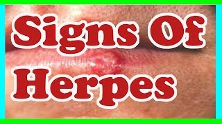 Signs Of herpes  Symptoms Of herpes [upl. by Nevins178]