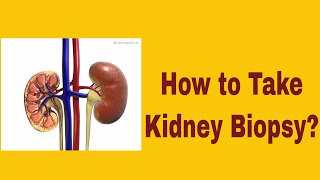 Kidney Cancer Biopsy Procedure [upl. by Barboza865]