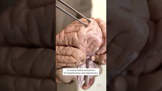 Live Parasitic Worm Removed From Woman’s Brain shorts [upl. by Aynodal]