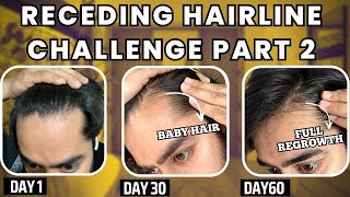 30 days HAIRLINE REGROWTH challenge PART 2  सिर्फ 1 महीने मैं RECEDING HAIRLINE REGROW करो [upl. by Rosalba]