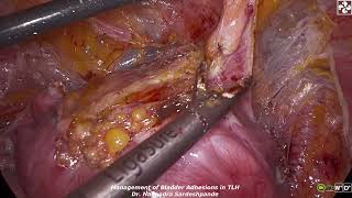 Management of bladder adhesions in TLH [upl. by Eiramlatsyrk]