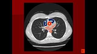 Normal Chest CT with labels [upl. by Wildon]