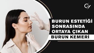 Burun Estetiği Sonrasında Ortaya Çıkan Burun Kemeri [upl. by Llenaj]