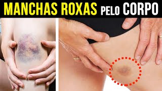 MANCHAS ROXAS no corpo com frequencia O QUE FAZER [upl. by Mossolb]