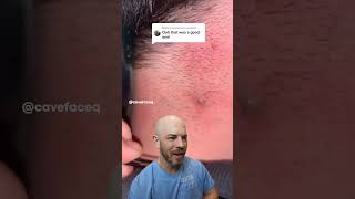 EXTREME ingrown hair drreacts ingrownhair supersatisfying [upl. by Llerrat830]