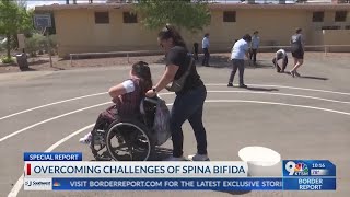 Girl with spina bifida overcomes challenges despite diagnosis [upl. by Biel]