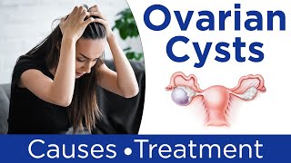 ❇️ What are Ovarian Cysts  💹Ovarian Cysts Symptoms Causes And Treatment in Hindi [upl. by Kram]