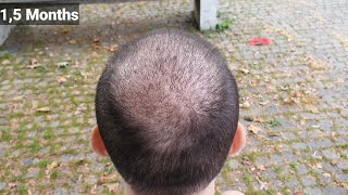 FUE Hair Transplant Timeline I Day 1 to Day 365 I Before amp After [upl. by Eldoria876]