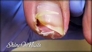 Curled ToenailIngrown Toenail InfectionRemoval Of Ingrown Toenail satisfying shineonnails [upl. by Ric]