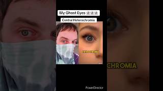 Central Heterochromia Doctors Opinion [upl. by Nnylear288]