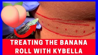 Treating The Banana Roll With Kybella  Dr Steven F Weiner [upl. by Pelletier]