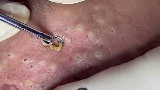 blackheads New this week 2023 [upl. by Eidac]