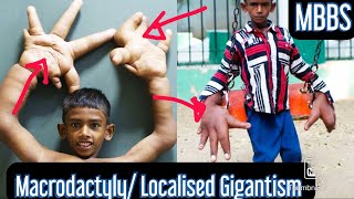 Macrodactyly Localised Gigantism A Rare Disorder medicine mbbs neetpg usmle inicet neet [upl. by Adnwahsar]