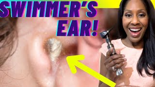 SWIMMER’S EAR Otitis Externa Treatments Causes amp Prevention A Doctor Explains [upl. by Karlee666]