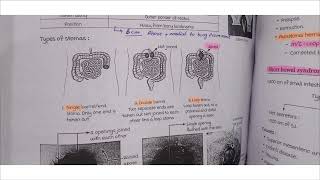 stomasileostomy vs colostomysurger final year lower gi lecture [upl. by Pollak87]