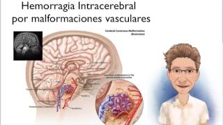 HEMORRAGIA INTRACEREBRAL CONCEPTO Y CLASIFICACIÓN [upl. by Amari420]