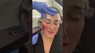 MORPHEUS8 for skin tightening [upl. by Hastie]