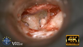 Traumatic Incus Dislocation  Total Ossicular Reconstruction  Malleus Relocation amp Silastic Banding [upl. by Fortier]