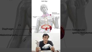 What is Kehr’s Sign Infarction of spleen splenic rupture shorts clinicalanatomyofspleen [upl. by Lenhart]