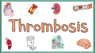 Thrombosis  Definition Causes Types Morphology Fate of a Thrombus amp Clinical manifestations [upl. by Yeung]