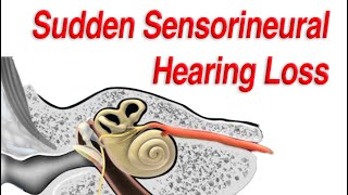 Sudden Sensorineural Hearing Loss Diagnosis Causes and Treatment [upl. by Nehemiah281]