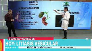 Litiasis vesicular cómo prevenir a tiempo [upl. by Hurleigh]