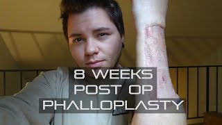 FTM  8 Weeks Phalloplasty Post Op [upl. by Eissirc843]