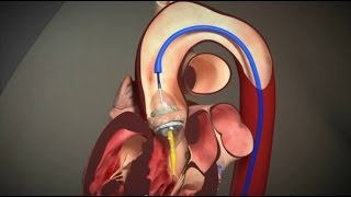 Transcatheter Aortic Valve Replacement  TAVR [upl. by Acker840]