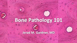 Bone Tumor Pathology 101 Osteosarcoma Chondrosarcoma and Mimics [upl. by Reckford]