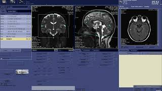 BRAIN MRV Planning with GE Scanner [upl. by Sosna422]