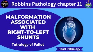 Malformations Associated With RighttoLeft Shunts Tetralogy of FallotRobbins Pathologypathology [upl. by Nimaynib]