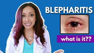 What Is Blepharitis Eye Doctor Explains [upl. by Gader656]