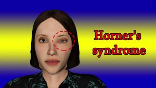 Horners syndrome  Symptoms and causes [upl. by Hodosh150]